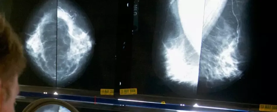 El Covid-19 redujo la supervivencia de pacientes con cáncer