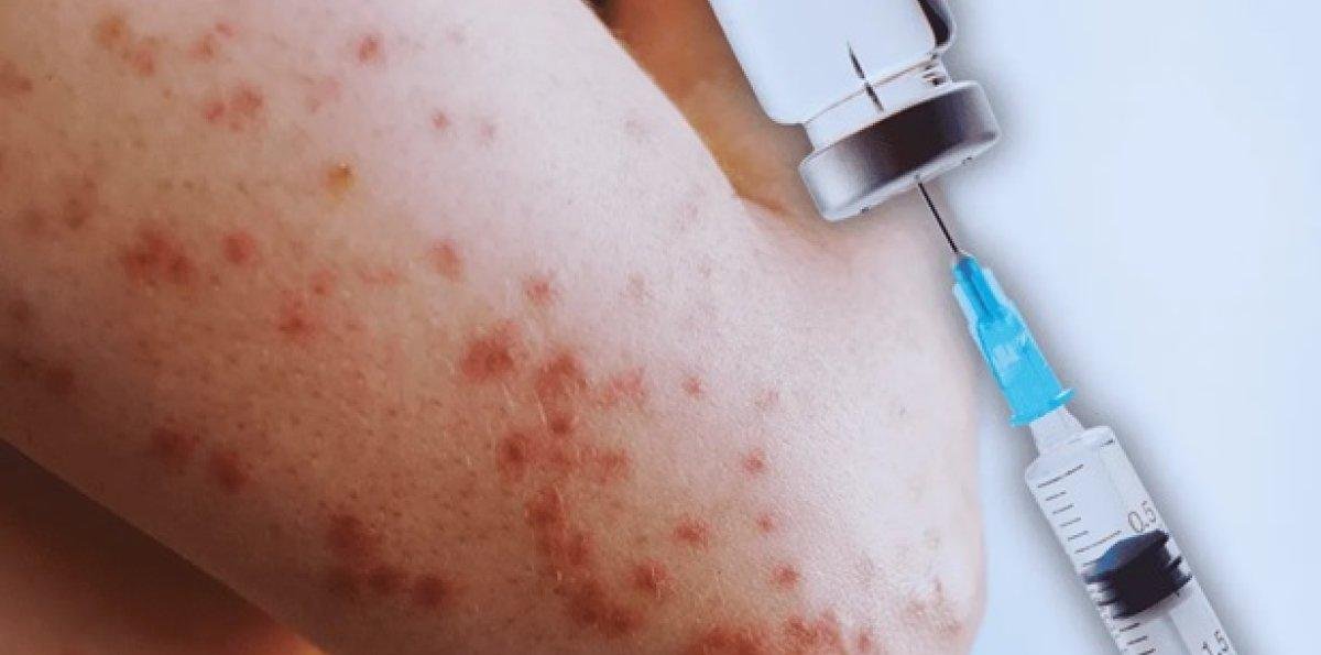 Alarma a dominicanos en NYC por aparición del sarampión