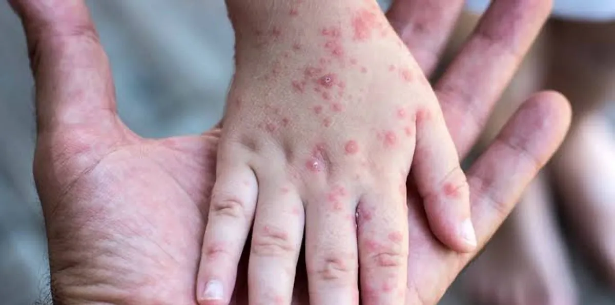 Alertan dominicanos en EUA sobre resurgimiento enfermedad sarampión