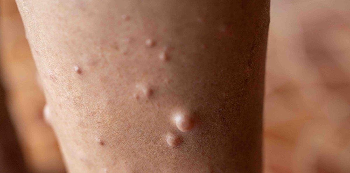 Retos del sistema frente a enfermedades raras